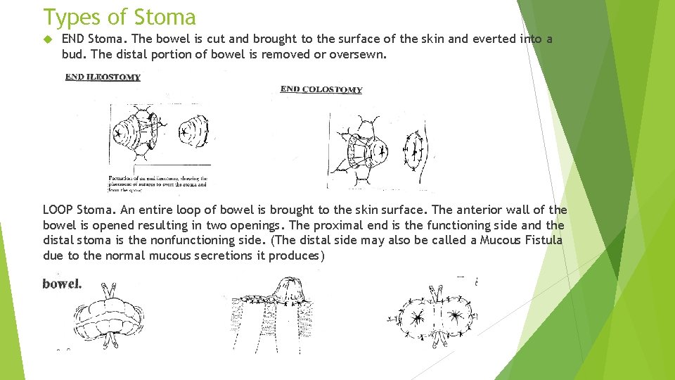 Types of Stoma END Stoma. The bowel is cut and brought to the surface