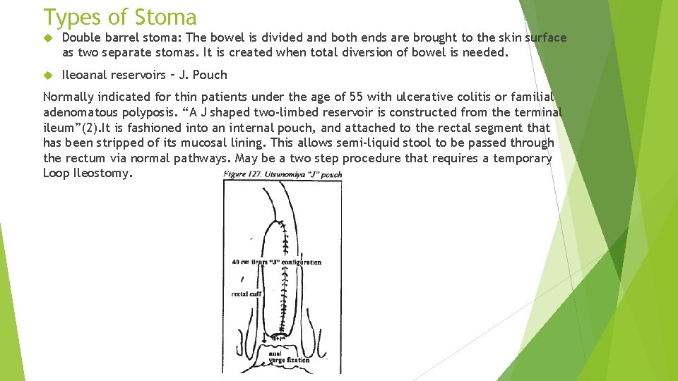 Types of Stoma Double barrel stoma: The bowel is divided and both ends are