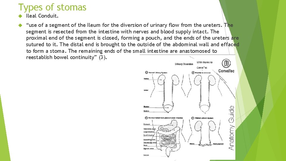 Types of stomas Ileal Conduit. “use of a segment of the Ileum for the