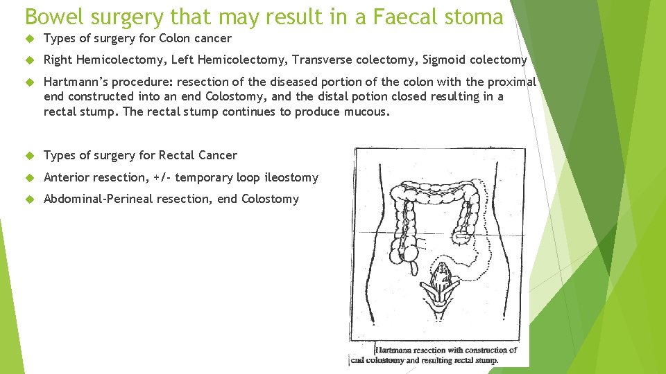 Bowel surgery that may result in a Faecal stoma Types of surgery for Colon