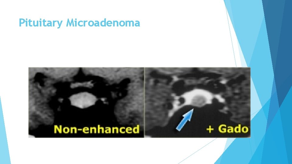 Pituitary Microadenoma 