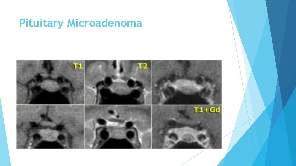 Pituitary Microadenoma 