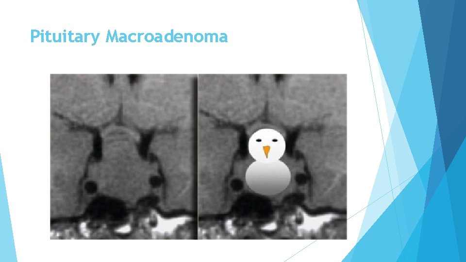 Pituitary Macroadenoma 