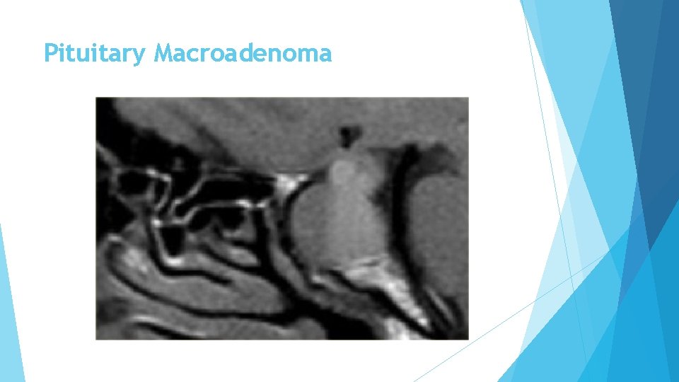 Pituitary Macroadenoma 