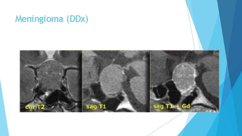 Meningioma (DDx) 