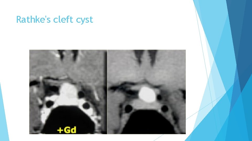 Rathke's cleft cyst 