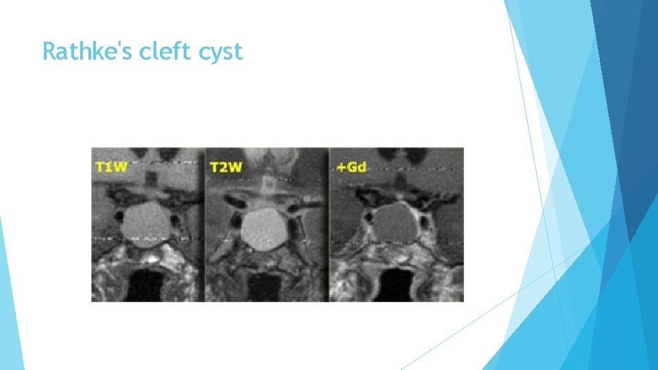 Rathke's cleft cyst 