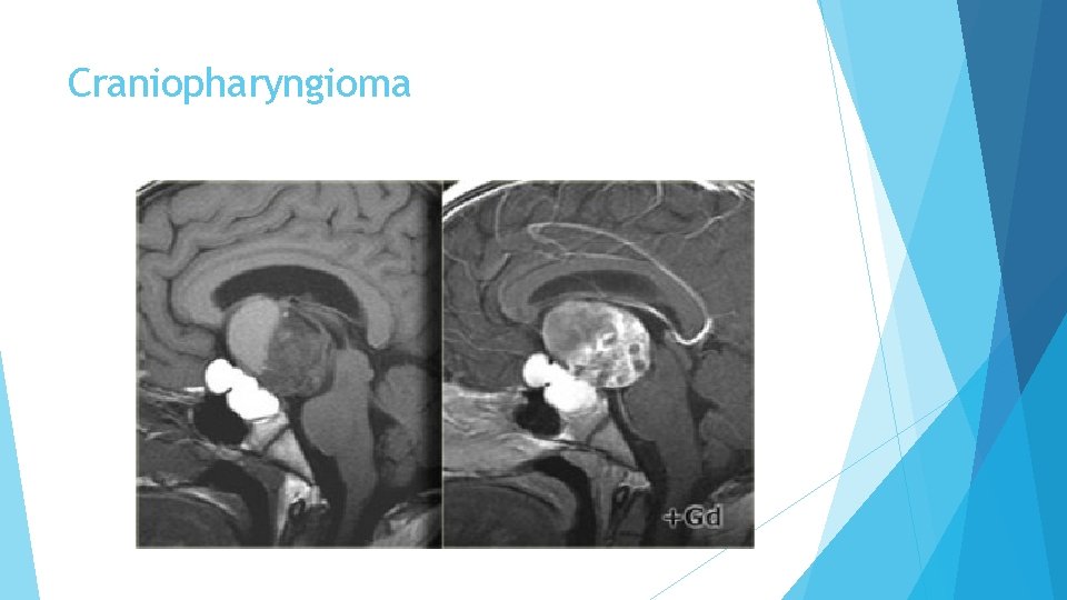 Craniopharyngioma 