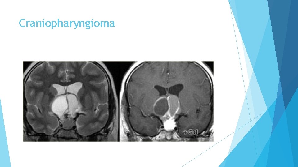 Craniopharyngioma 