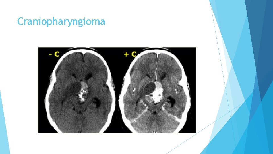 Craniopharyngioma 