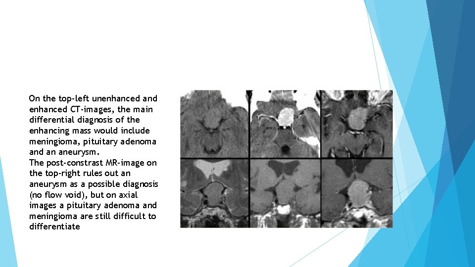 On the top-left unenhanced and enhanced CT-images, the main differential diagnosis of the enhancing