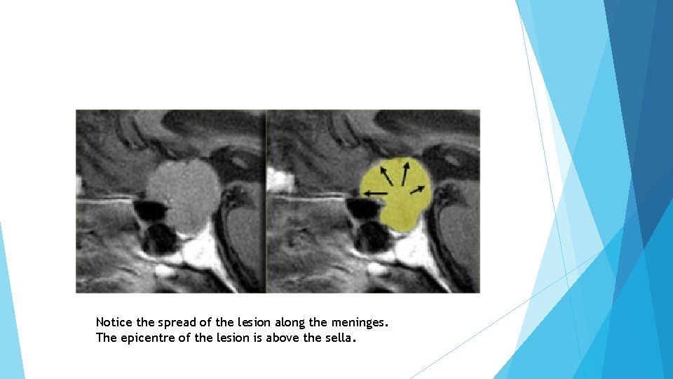 Notice the spread of the lesion along the meninges. The epicentre of the lesion