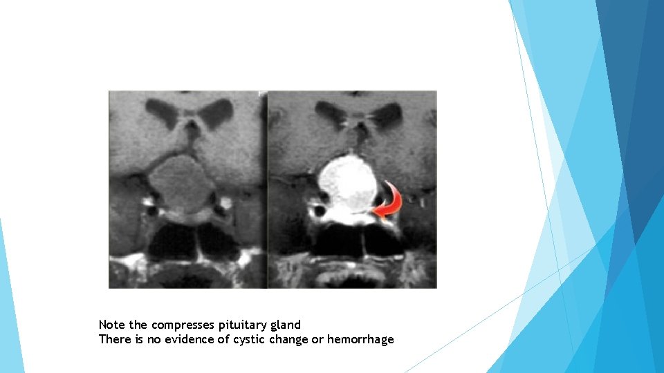 Note the compresses pituitary gland There is no evidence of cystic change or hemorrhage