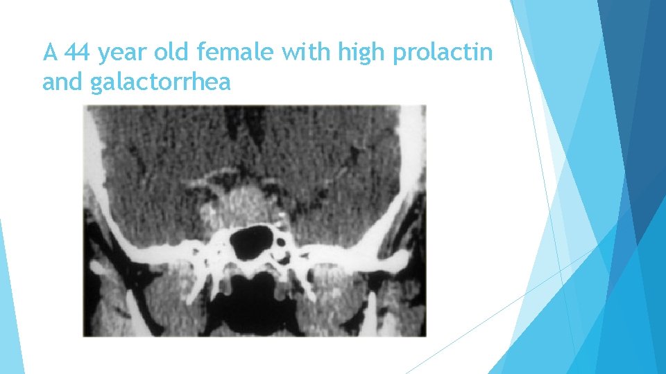 A 44 year old female with high prolactin and galactorrhea 