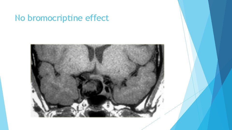 No bromocriptine effect 