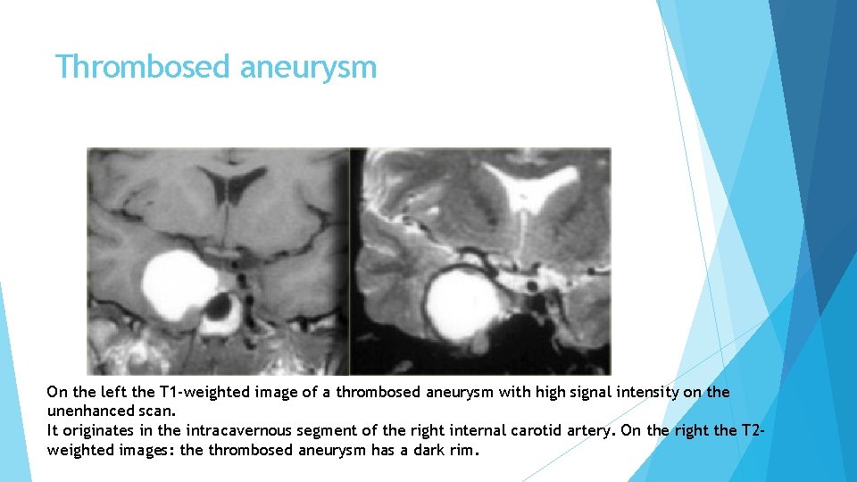 Thrombosed aneurysm On the left the T 1 -weighted image of a thrombosed aneurysm