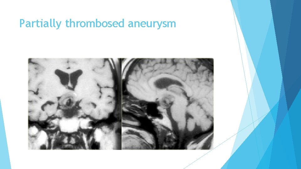 Partially thrombosed aneurysm 