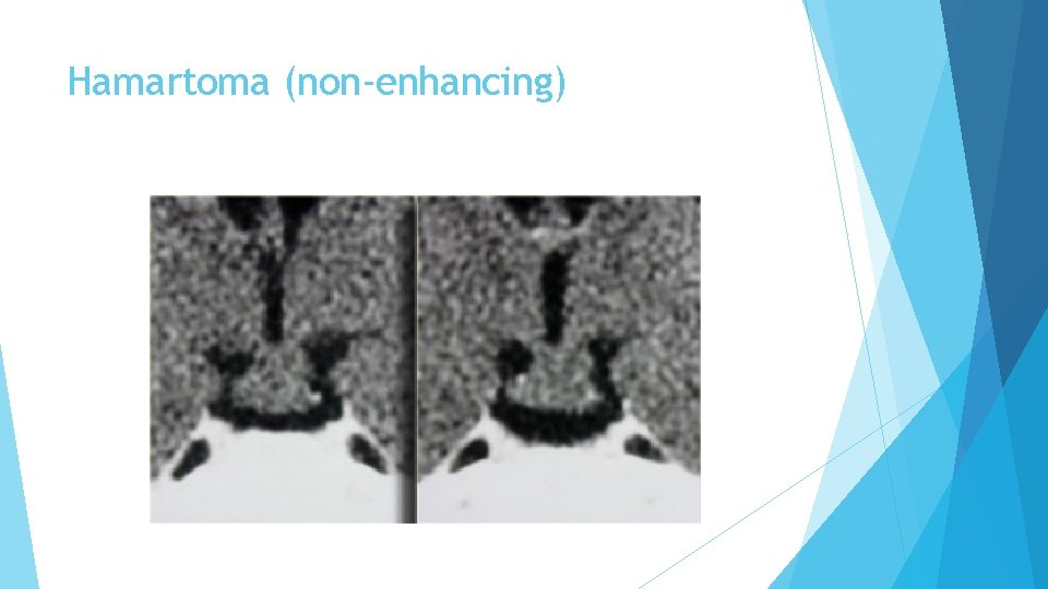 Hamartoma (non-enhancing) 