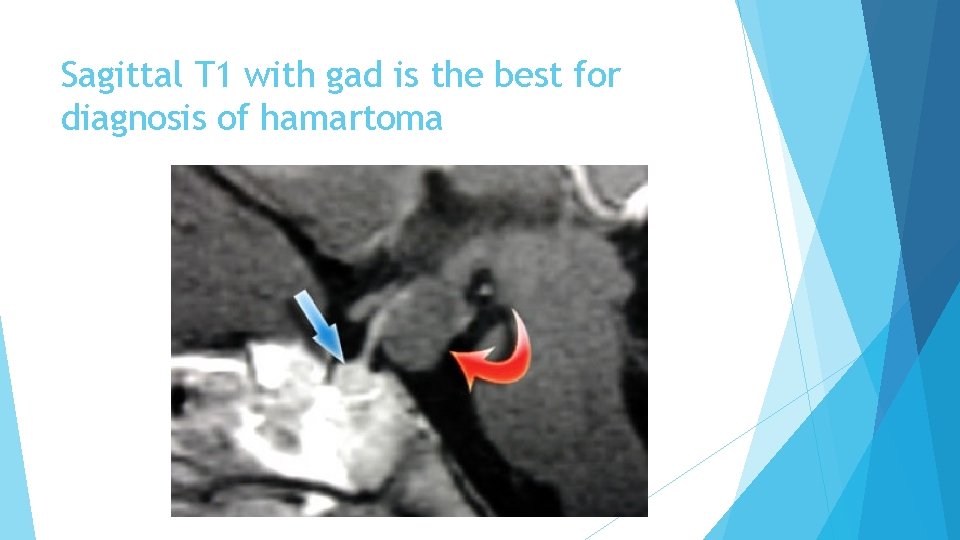 Sagittal T 1 with gad is the best for diagnosis of hamartoma 