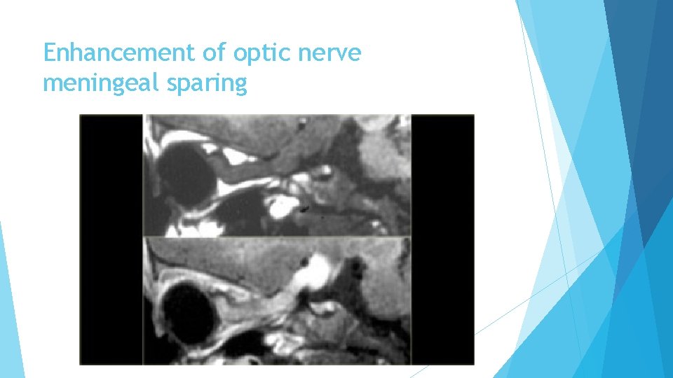 Enhancement of optic nerve meningeal sparing 