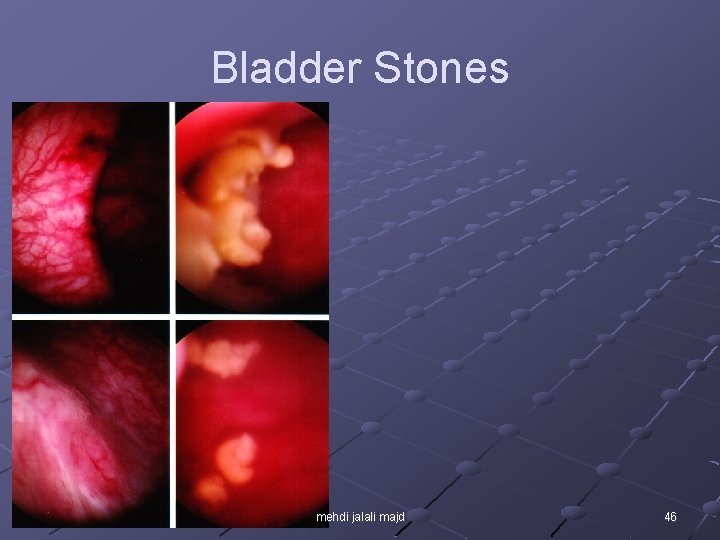 Bladder Stones mehdi jalali majd 46 