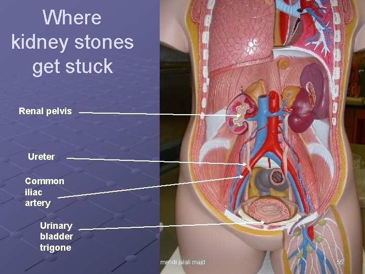 Where kidney stones get stuck Renal pelvis Ureter Common iliac artery Urinary bladder trigone