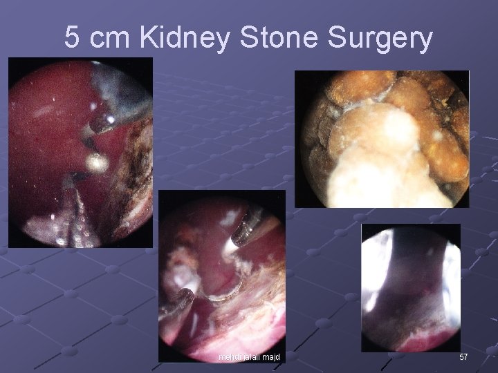 5 cm Kidney Stone Surgery mehdi jalali majd 57 