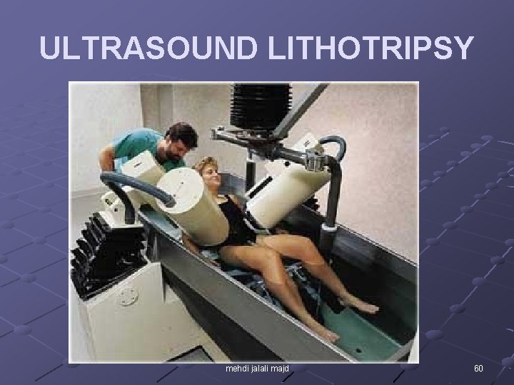 ULTRASOUND LITHOTRIPSY mehdi jalali majd 60 