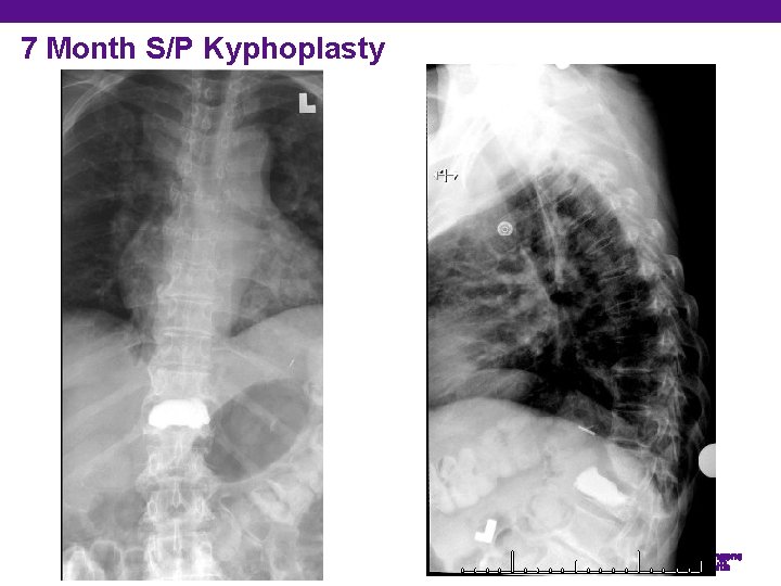 7 Month S/P Kyphoplasty Department of Orthopedic Surgery 