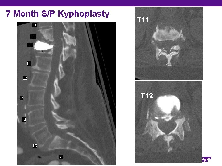 7 Month S/P Kyphoplasty T 11 T 12 Department of Orthopedic Surgery 