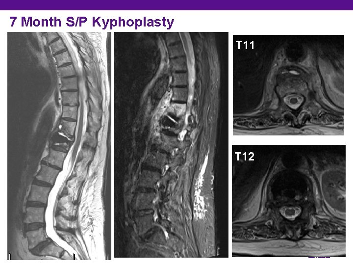 7 Month S/P Kyphoplasty T 11 T 12 12 Department of Orthopedic Surgery 