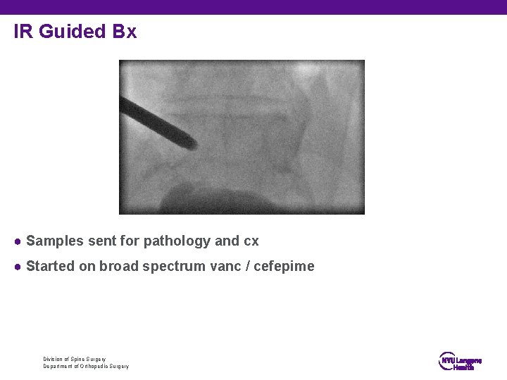 IR Guided Bx ● Samples sent for pathology and cx ● Started on broad