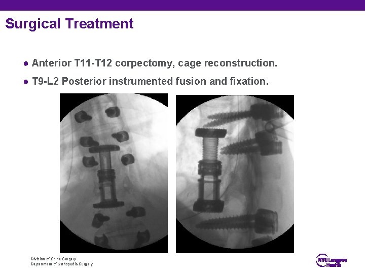 Surgical Treatment ● Anterior T 11 -T 12 corpectomy, cage reconstruction. ● T 9