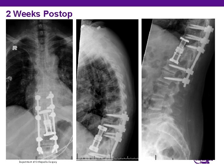 2 Weeks Postop Department of Orthopedic Surgery 