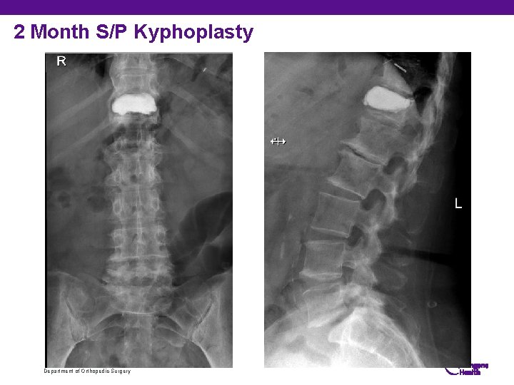 2 Month S/P Kyphoplasty Department of Orthopedic Surgery 