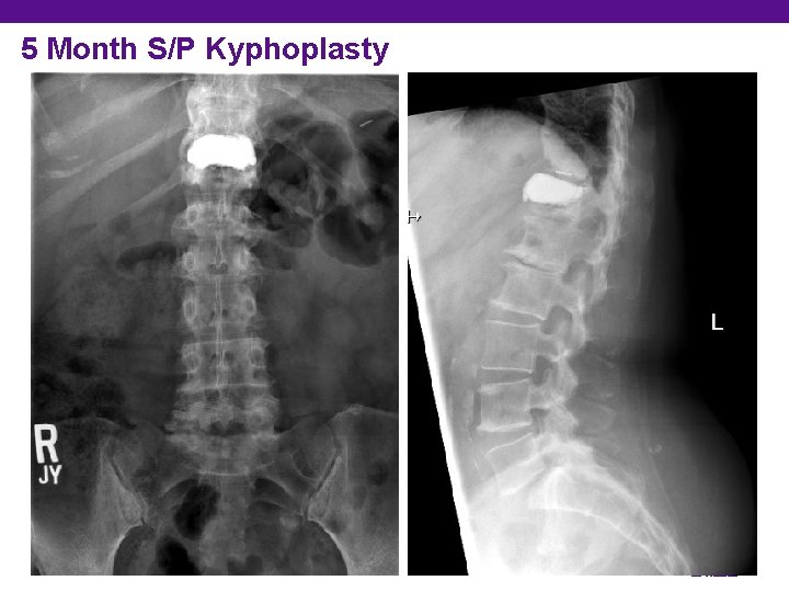 5 Month S/P Kyphoplasty 7 Department of Orthopedic Surgery 