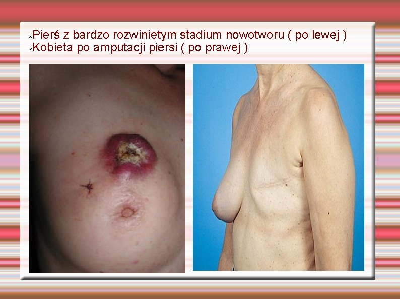 Pierś z bardzo rozwiniętym stadium nowotworu ( po lewej ) Kobieta po amputacji piersi