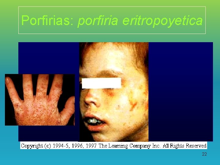 Porfirias: porfiria eritropoyetica 22 