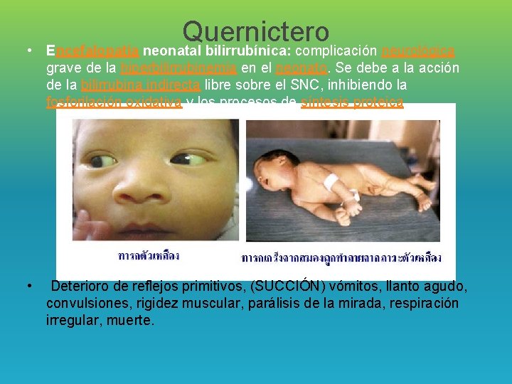 Quernictero • Encefalopatía neonatal bilirrubínica: complicación neurológica grave de la hiperbilirrubinemia en el neonato.