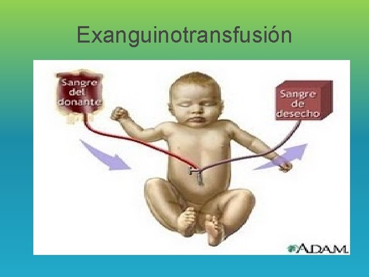 Exanguinotransfusión 