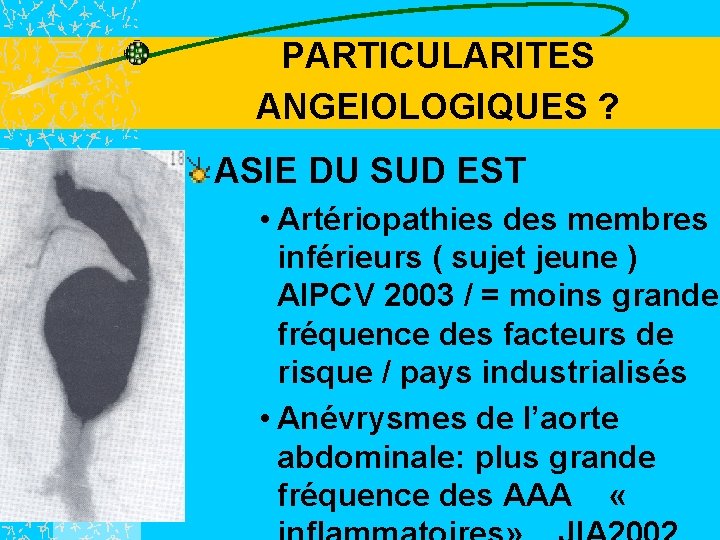 PARTICULARITES ANGEIOLOGIQUES ? ASIE DU SUD EST • Artériopathies des membres inférieurs ( sujet