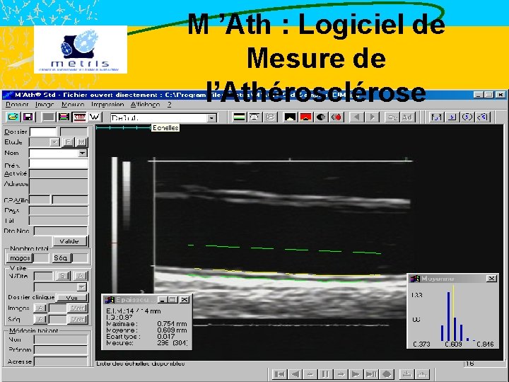 M ’Ath : Logiciel de Mesure de l’Athérosclérose 
