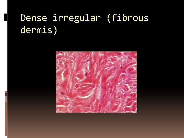 Dense irregular (fibrous dermis) 