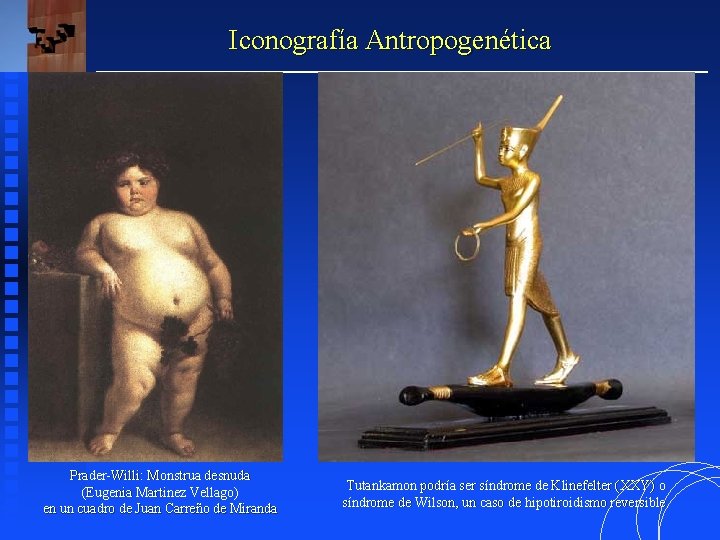 Iconografía Antropogenética Prader-Willi: Monstrua desnuda (Eugenia Martinez Vellago) en un cuadro de Juan Carreño