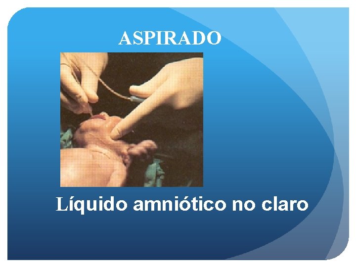 ASPIRADO Líquido amniótico no claro 