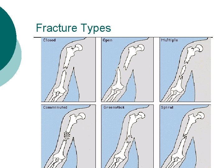 Fracture Types 