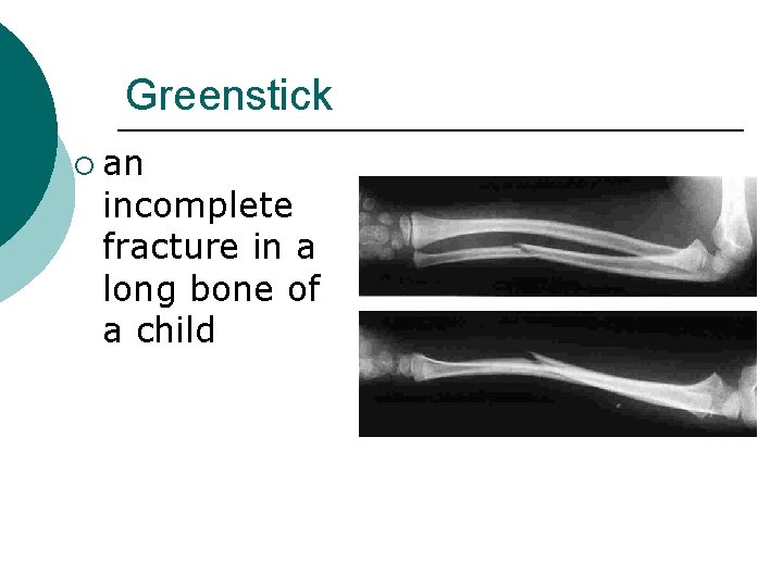 Greenstick ¡ an incomplete fracture in a long bone of a child 