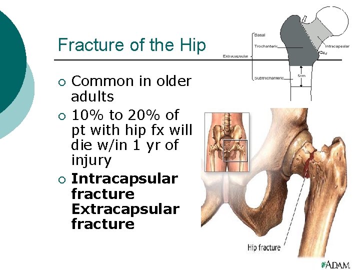 Fracture of the Hip ¡ ¡ ¡ Common in older adults 10% to 20%