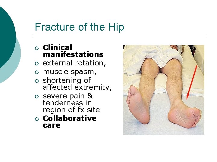 Fracture of the Hip ¡ ¡ ¡ Clinical manifestations external rotation, muscle spasm, shortening