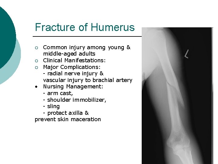 Fracture of Humerus Common injury among young & middle-aged adults ¡ Clinical Manifestations: ¡